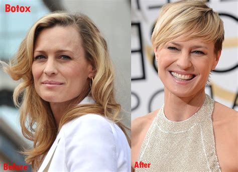 Robin Wright Plastic Surgery Before and After Pictures …