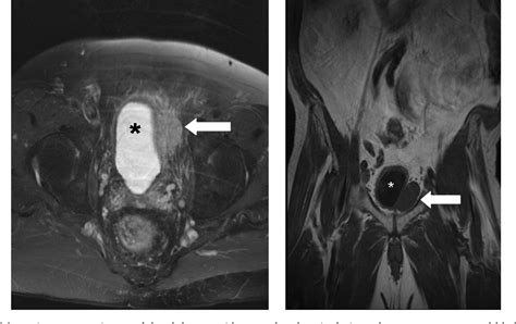 Robot-assisted laparoscopic excision of bladder wall …