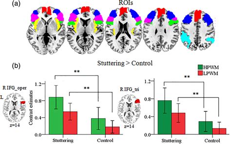 Roi brain.  Within SPAMALIZE's BrainMaker program, a ROI is defined in three dimensions, and i...