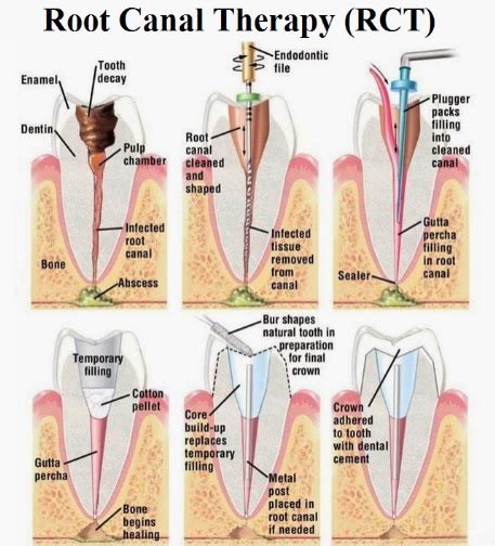 Root Canal Treatment - dentist sydney