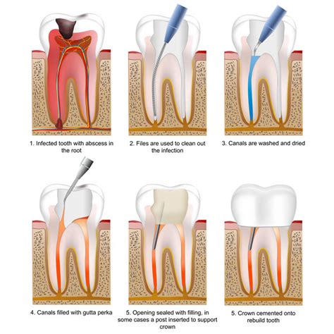 Root canal therapy tooth #31 in 2015. periapical bone normal ...