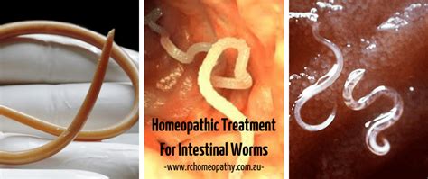Rope worm What is it and what are the symptoms 