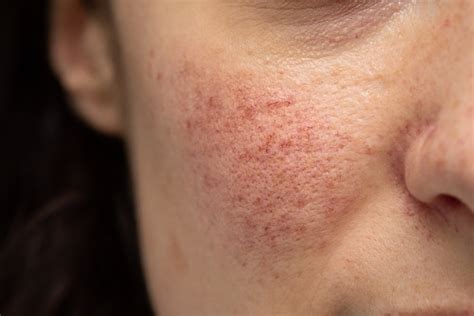 Rosacea: Obat, Gejala, Penyebab dll. • Hello Sehat