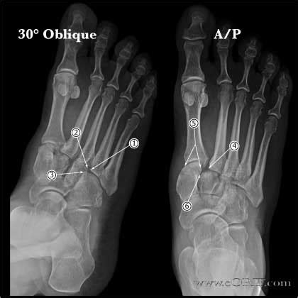 Share. What ICD-10 Codes are Used for Right Ankle Fracture. Here are the most common right ankle fracture ICD codes practitioners can use for coding and billing according to …. 