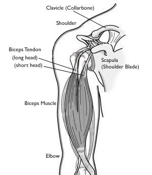 Rupture Long Head Biceps - Physiopedia / Biceps Tendon Rupture …