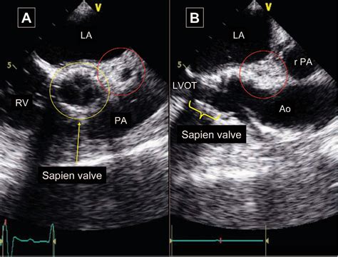 Rupture of the Device Landing Zone During Transcatheter Aortic …