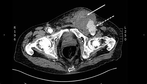 Ruptured Superficial Femoral Artery Anastomotic Pseudoaneurysm after …