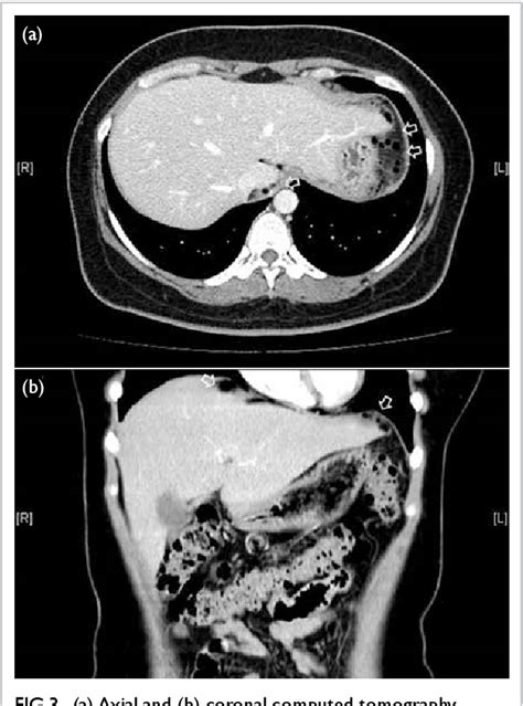 Ruptured ovarian teratoma with granulomatous peritonitis