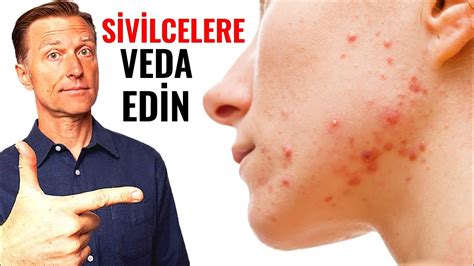 SİVİLCELERE SON!!!!!!!!. 