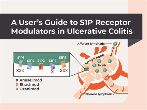 S1P Receptor Modulators for Ulcerative Colitis Everyday Health