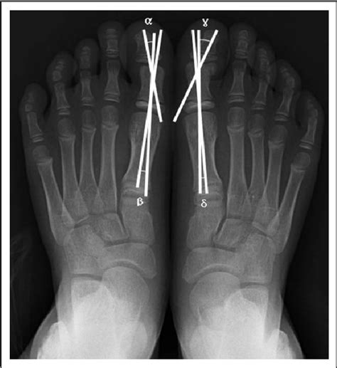 S92.415A - ICD-10-CM Nondisp fx of proximal phalanx of left great toe…