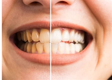 Safe And Easy Home Remedies For A Brighter, Whiter Smile Without Tooth ... - balustradellc