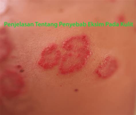 Sakit Kulit Eksim - balustradellc
