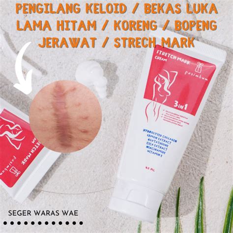 Salep Untuk Stretch Mark - balustradellc