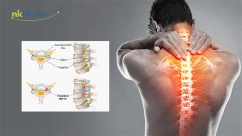 SARAF KEJEPIT TULANG BLIKAT 1KX TERAPI LANGSUNG … - balustradellc