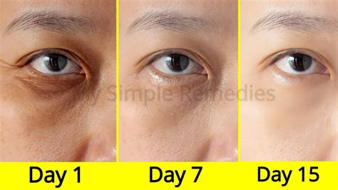 Say Goodbye to Puffy Eyes | Clear Skin Clinic - balustradellc