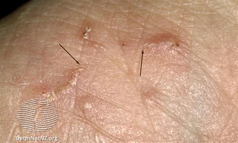 Scabies Rash Straight Line Itchy Bumps | Stop the Itch - balustradellc