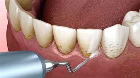 Scaling Gigi: Manfaat, Prosedur, dan Biayanya - balustradellc