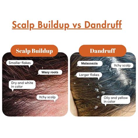 Scalp Buildup Symptoms - balustradellc