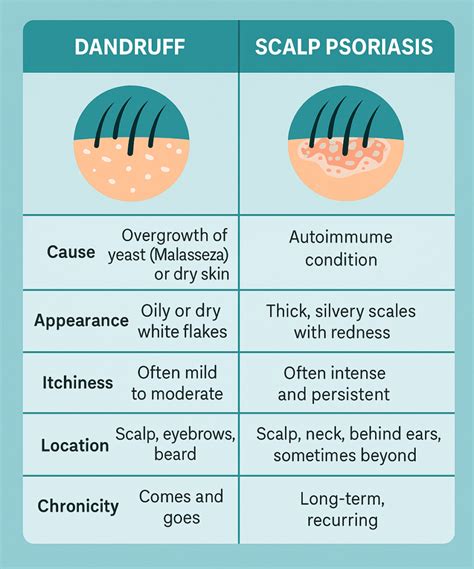 Scalp Psoriasis: Causes, Treatment, vs. Dandruff, and … - balustradellc