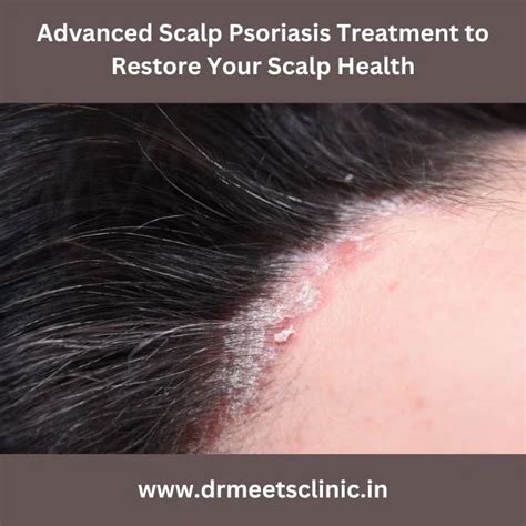 Scalp psoriasis: Diagnosis and treatment - balustradellc