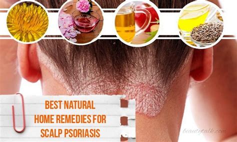 Scalp psoriasis: Shampoos, home remedies, and causes - balustradellc