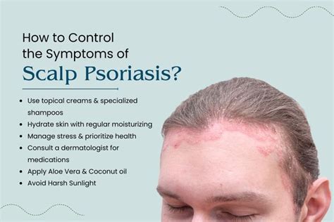 Scalp Psoriasis: Symptoms, Causes & Treatment - balustradellc