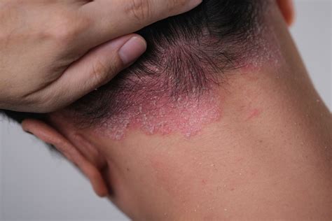 Scalp Psoriasis | Treatment and Causes - balustradellc