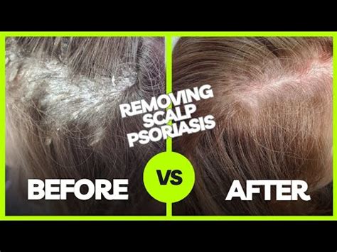 Scalp Psoriasis Plaque Removal Tool For Curly Hair - balustradellc