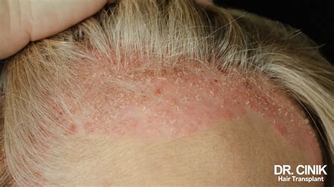 Scalp psoriasis tips - balustradellc