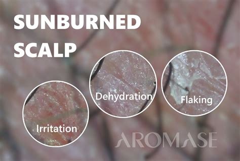 Scalp Sunburn: Symptoms, Treatment, and Prevention - balustradellc