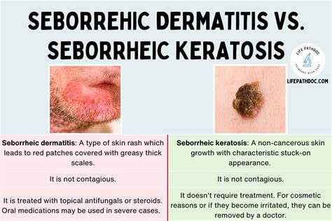 Seborrheic Keratosis Vs Seborrheic Dermatitis - balustradellc