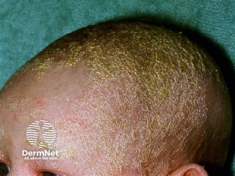 Self Care Briefing for Clinicians: Cradle Cap (Seborrhoeic Dermatitis ... - balustradellc