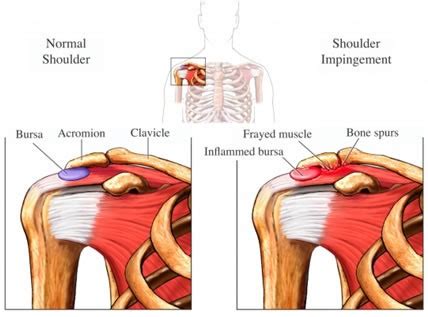 SHOULDER IMPINGEMENT SYNDROME (SINDROMA JEPITAN BAHU…