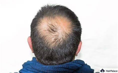 Signs of Balding at 20: Causes, Treatments, - balustradellc
