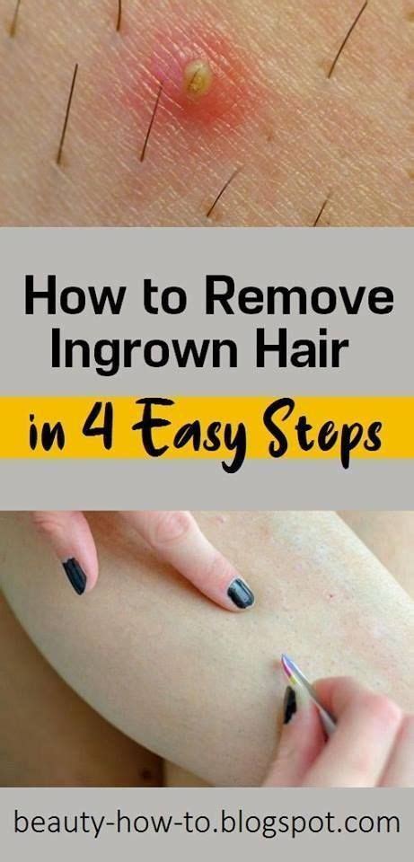Simple how to remove ingrown beard hair tips - Hair Away By Laser - balustradellc