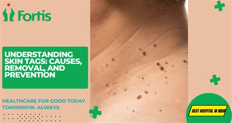 Skin Tags: Causes and Removal (With Pictures) - GoodRx - balustradellc