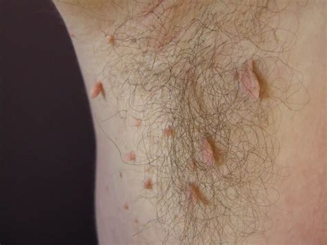 Skin tags - causes, symptoms, and removal | healthdirect - balustradellc