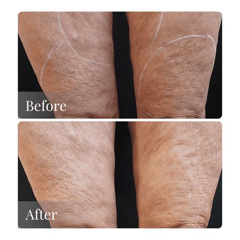 Snatch Back Your Confidence: How to Get Your Skin to Tighten After ... - balustradellc