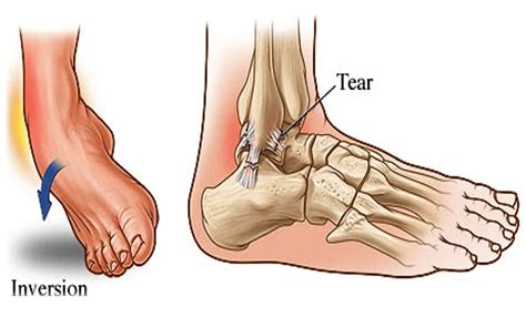 Sprained ankle - Diagnosis and treatment - Mayo Clinic - balustradellc