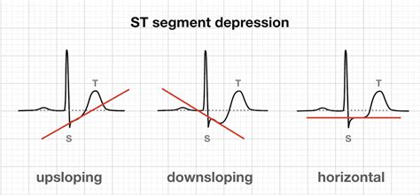 ST Depression