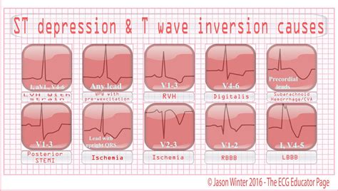 ST depression on ECG What it means and causes