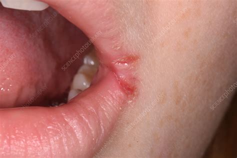 Stomatitis Angularis - balustradellc