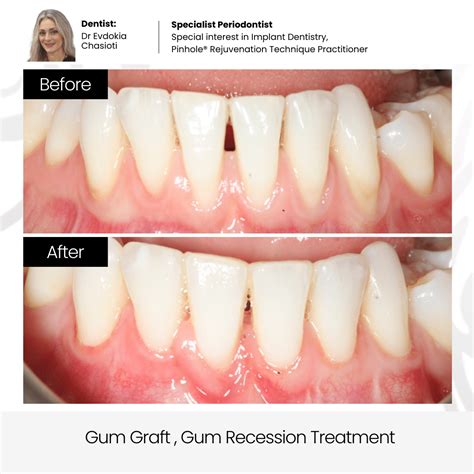Stop hiding your smile! Sick of receding gums, stubborn ... - balustradellc