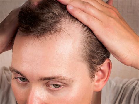 Stop settling for thinning hair and a receding hairline that ... - balustradellc