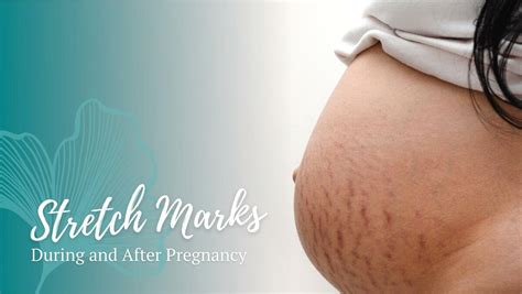 Stretch Mark - Penyebab, Gejala, Pengobatan, … - balustradellc
