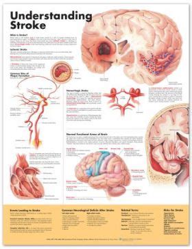 Stroke - World Health Organization (WHO) - balustradellc