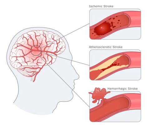 Stroke - Gejala, Penyebab, dan Pengobatan - Alodokter - coolestguyplanet.net