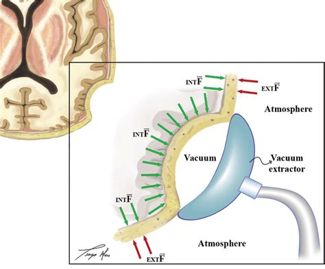 SUCTION EFFECTS