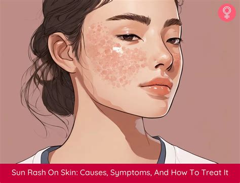 Sun rash: What it is, symptoms, causes, and treatments - balustradellc